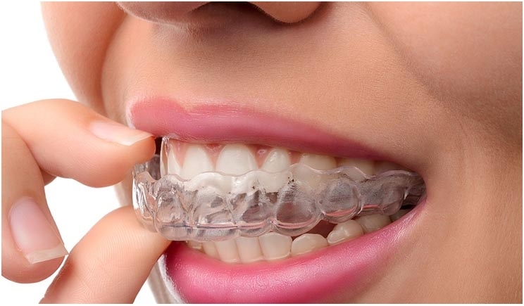Dentofacial orthopedics/Aligners 1
